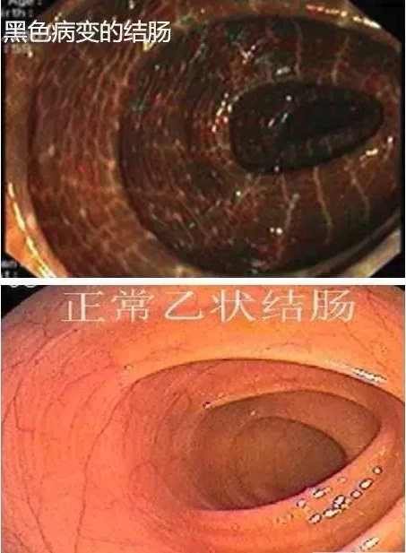 我的大肠怎么黑了?——结肠黑变病17问